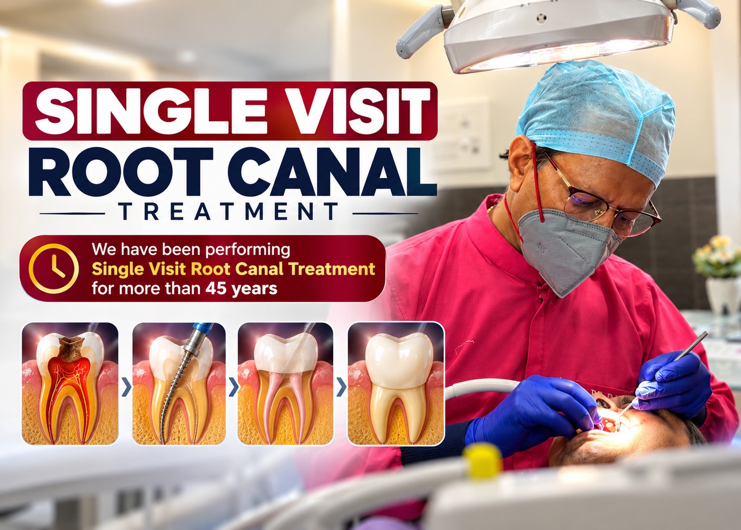 Single-Visit Root Canal