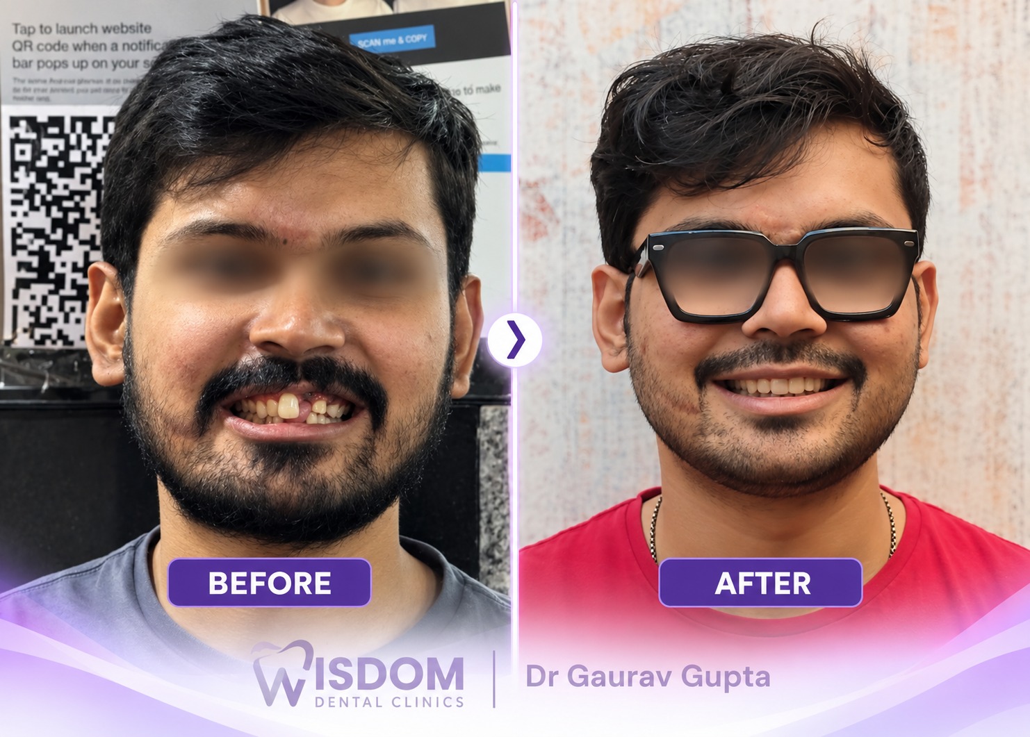 Before and After Smile Transformation 2